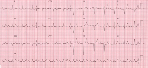 Detail Gambar Ekg Sinus Bradikardi Nomer 13