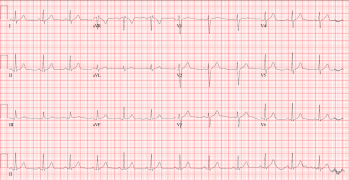 Detail Gambar Ekg Sinus Bradikardi Nomer 19