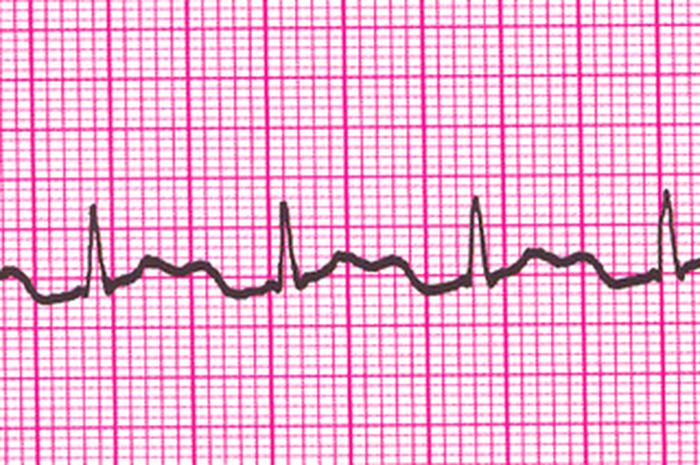 Detail Gambar Ekg Sinus Bradikardi Nomer 3