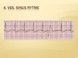 Detail Gambar Ekg Sinus Bradikardi Nomer 25