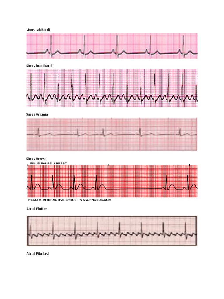 Detail Gambar Ekg Sinus Bradikardi Nomer 27