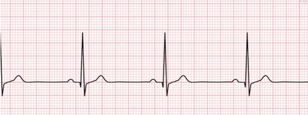 Detail Gambar Ekg Sinus Bradikardi Nomer 4