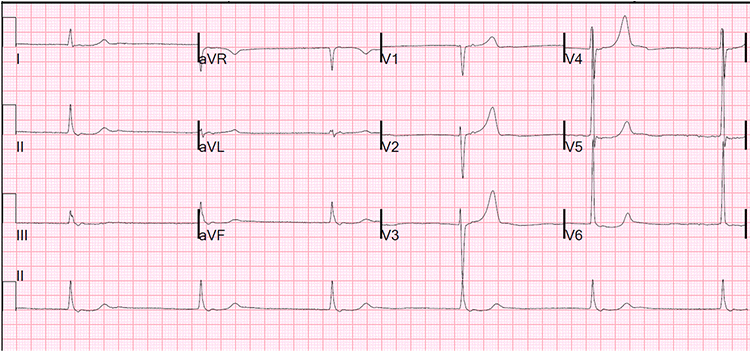 Detail Gambar Ekg Sinus Bradikardi Nomer 32