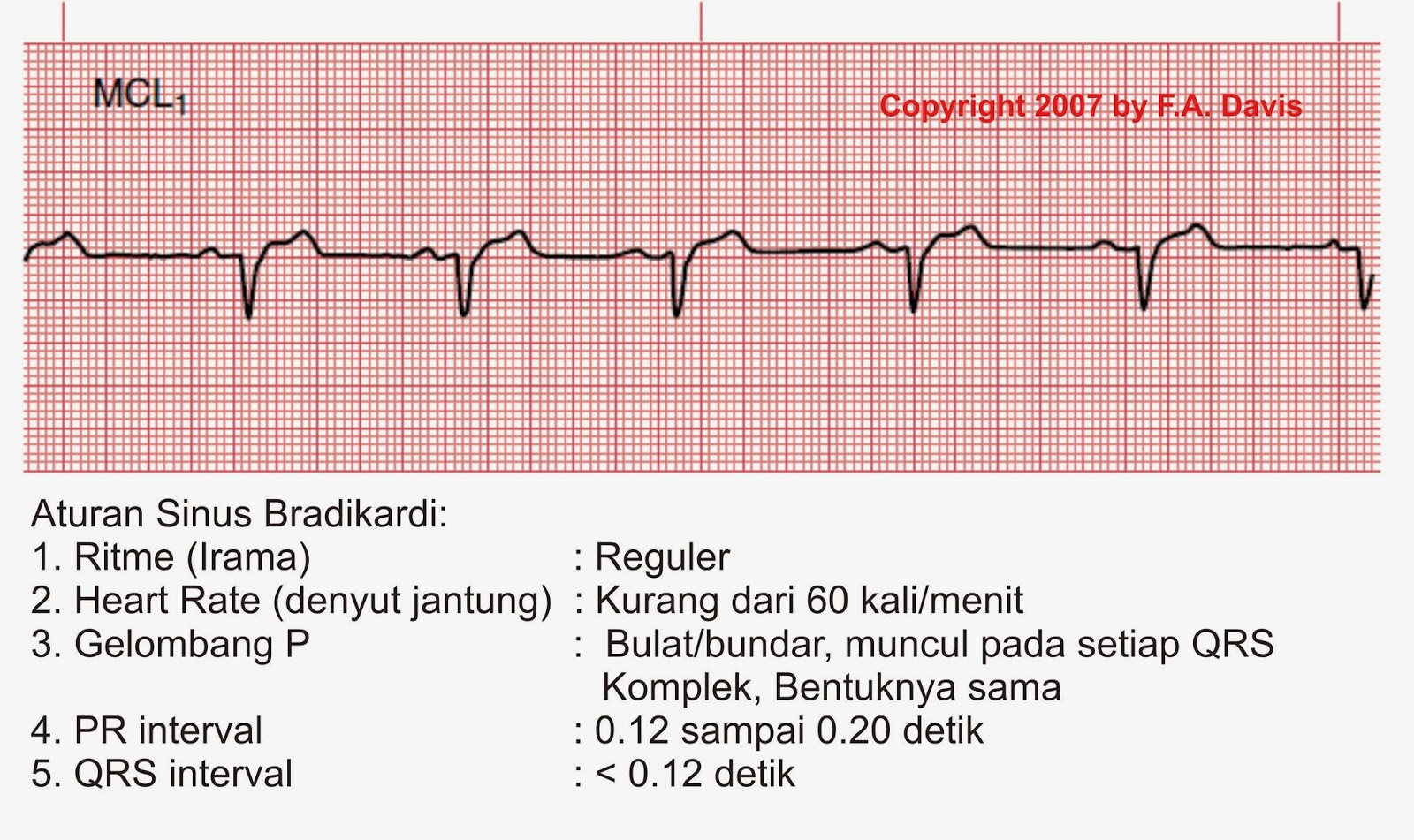 Detail Gambar Ekg Sinus Bradikardi Nomer 33