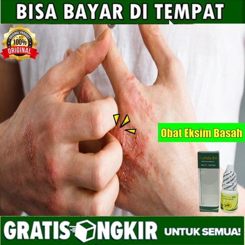 Detail Gambar Eksim Basah Dan Kering Nomer 42