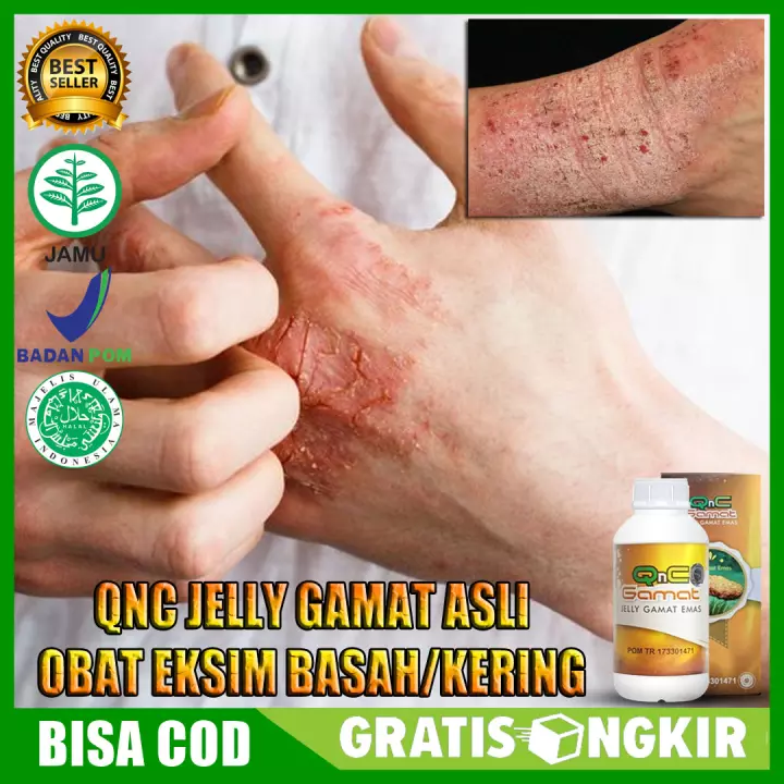 Detail Gambar Eksim Basah Dan Kering Nomer 44