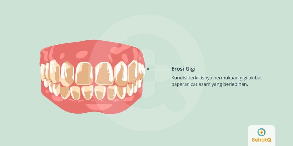 Detail Gambar Email Gigi Nomer 9