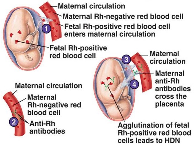 Detail Gambar Eritroblastosis Fetalis Nomer 6