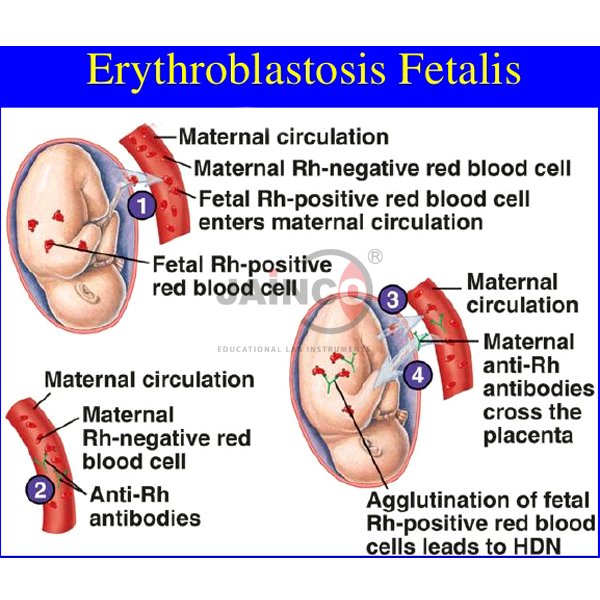 Detail Gambar Eritroblastosis Fetalis Nomer 8