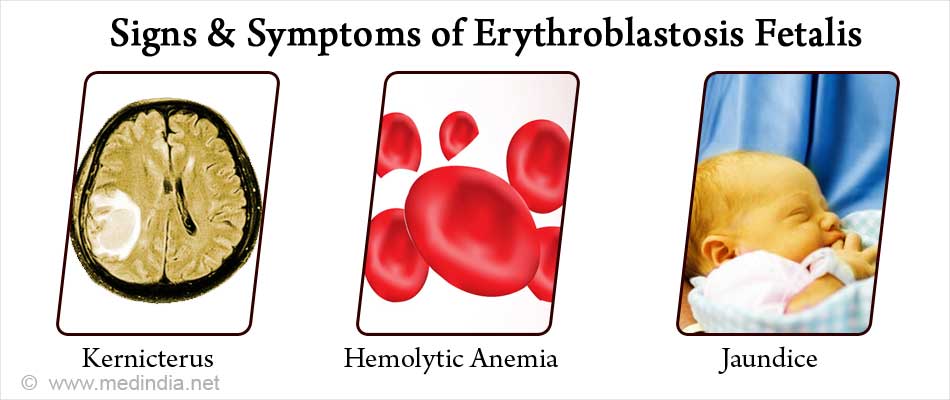 Detail Gambar Eritroblastosis Fetalis Nomer 13