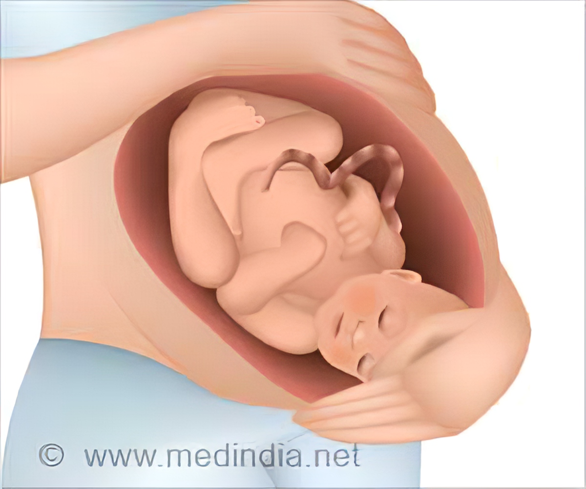 Detail Gambar Eritroblastosis Fetalis Nomer 14