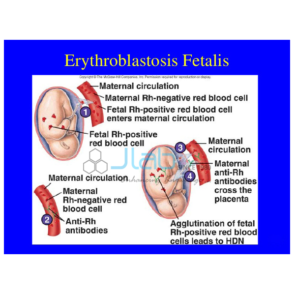 Detail Gambar Eritroblastosis Fetalis Nomer 19