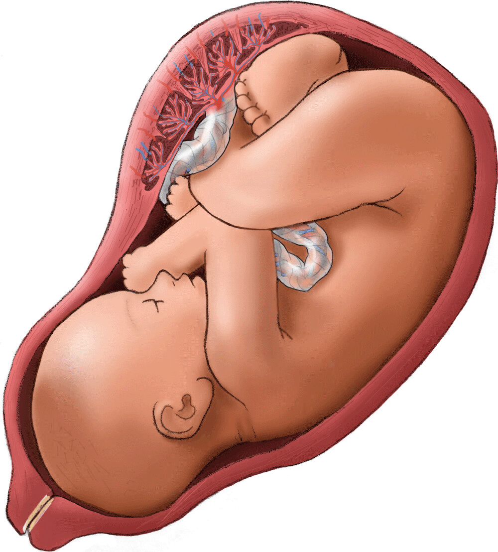 Detail Gambar Eritroblastosis Fetalis Nomer 21