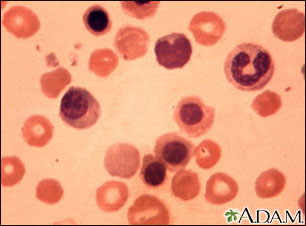 Detail Gambar Eritroblastosis Fetalis Nomer 26