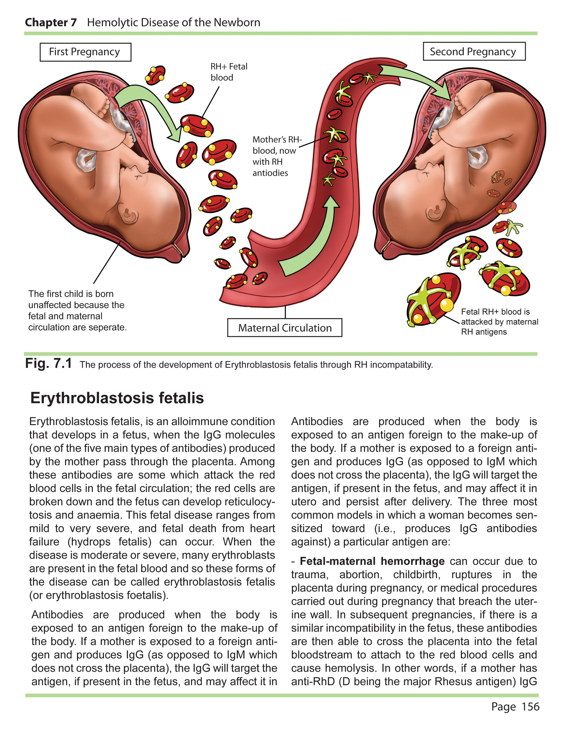 Detail Gambar Eritroblastosis Fetalis Nomer 2