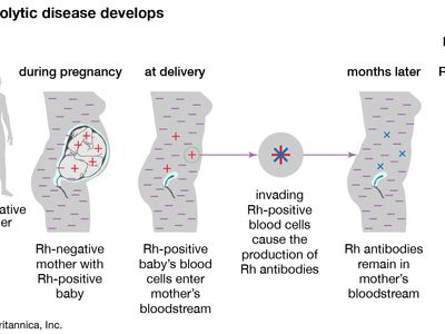 Detail Gambar Eritroblastosis Fetalis Nomer 3