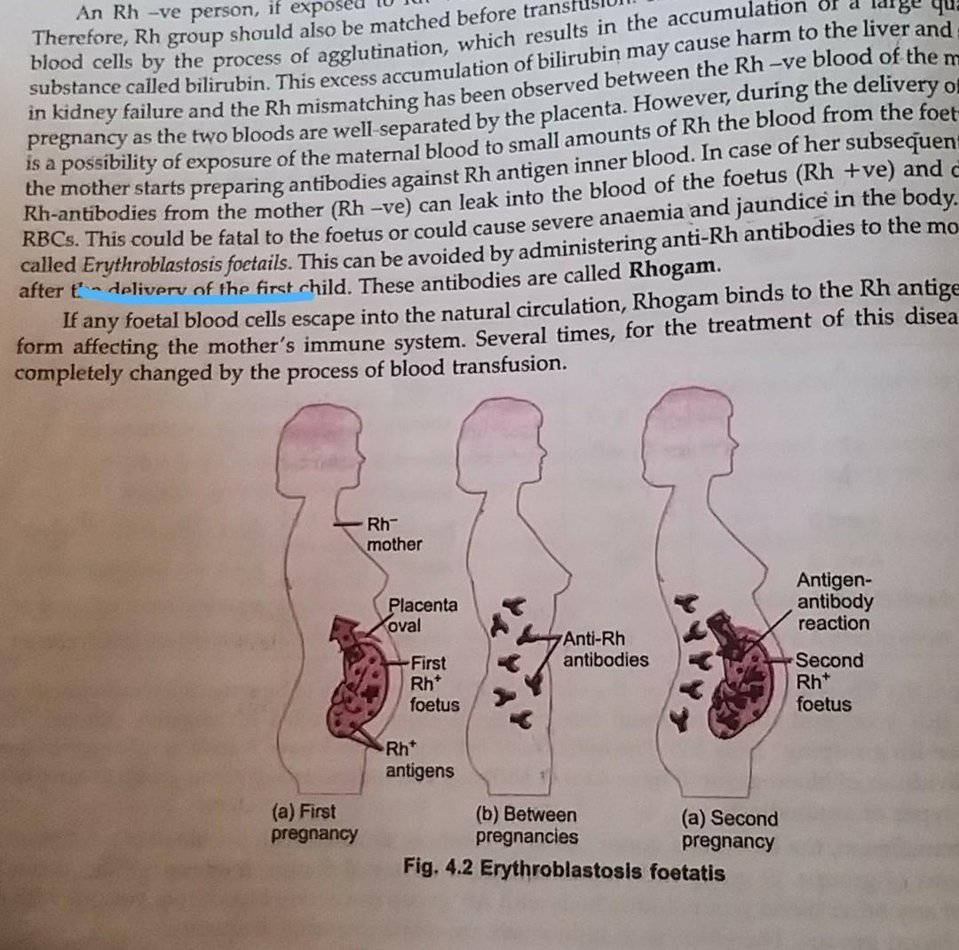 Detail Gambar Eritroblastosis Fetalis Nomer 36