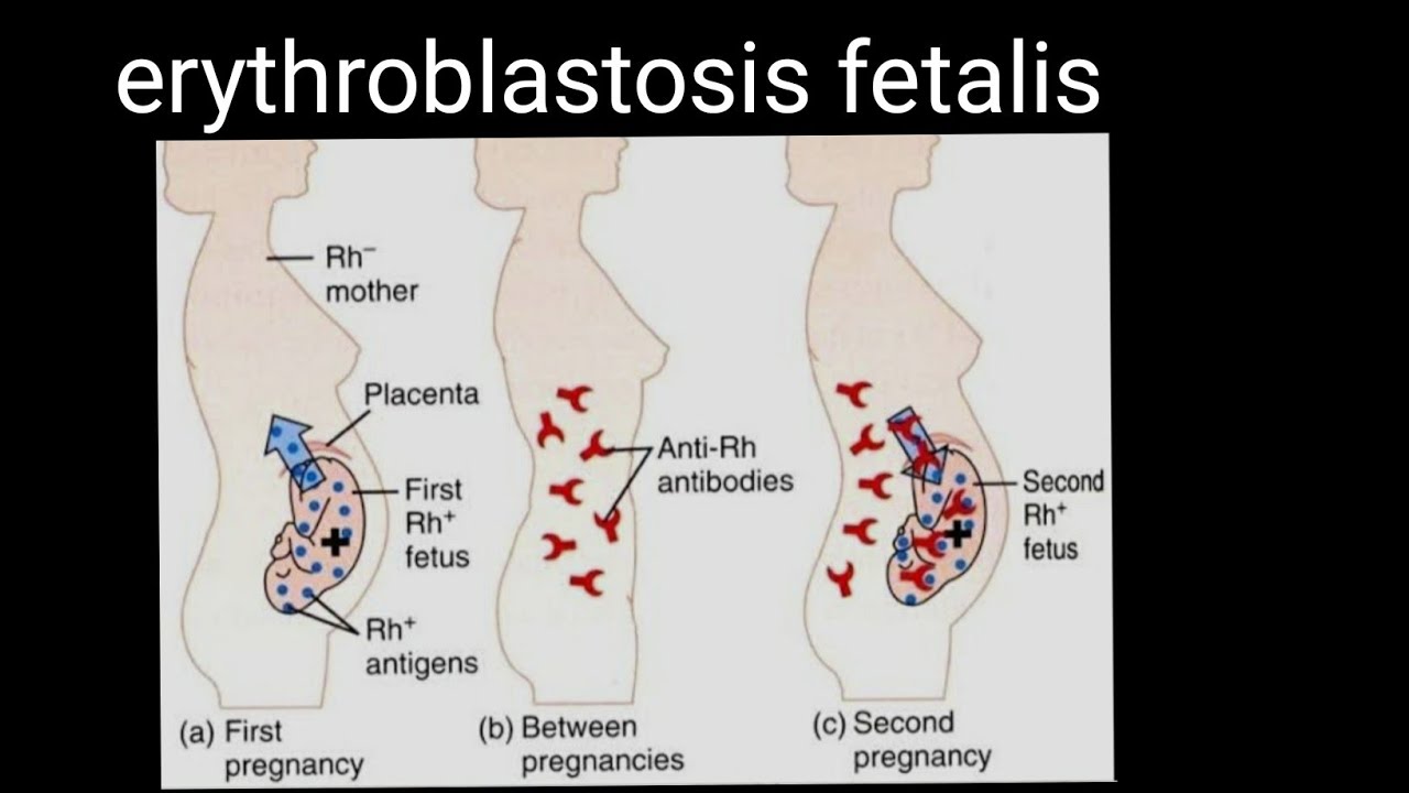 Detail Gambar Eritroblastosis Fetalis Nomer 39