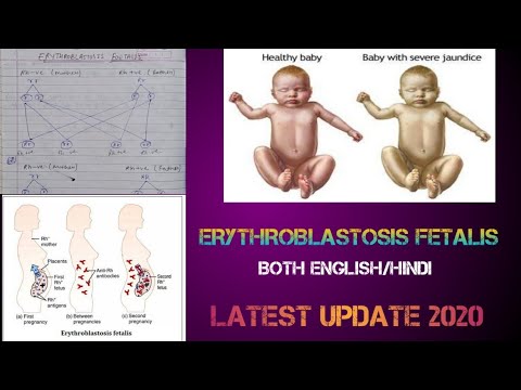 Detail Gambar Eritroblastosis Fetalis Nomer 42