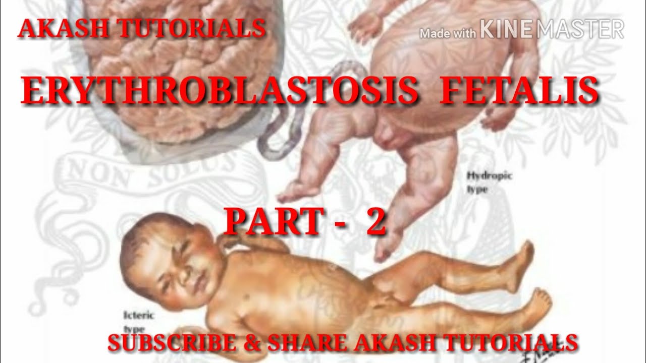 Detail Gambar Eritroblastosis Fetalis Nomer 43