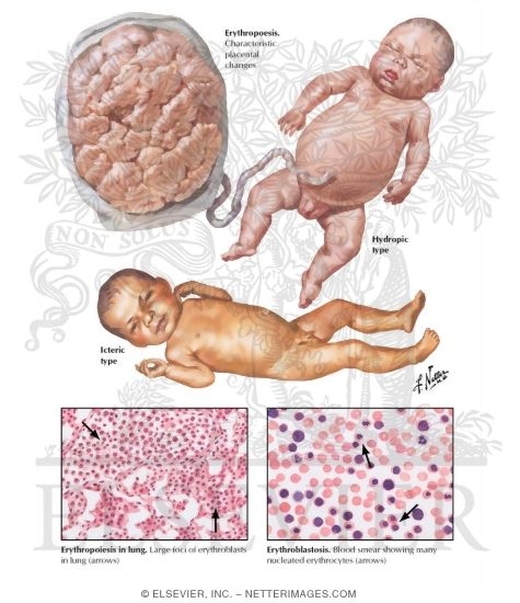 Detail Gambar Eritroblastosis Fetalis Nomer 4