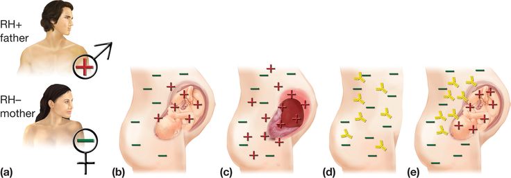 Detail Gambar Eritroblastosis Fetalis Nomer 5