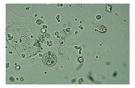 Gambar Eritrosit Pada Urine - KibrisPDR