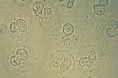 Detail Gambar Eritrosit Pada Urine Nomer 6