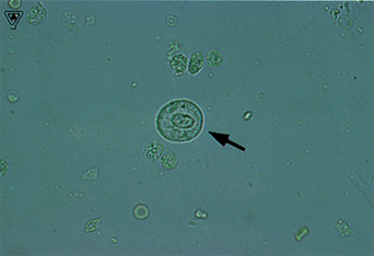 Detail Gambar Eritrosit Pada Urine Nomer 7
