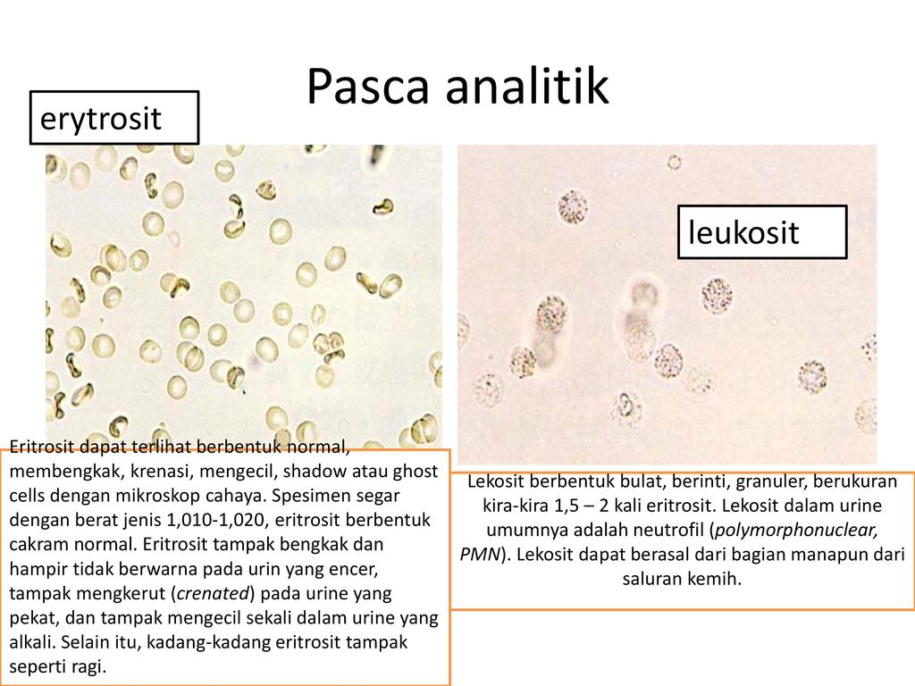 Detail Gambar Eritrosit Pada Urine Nomer 8