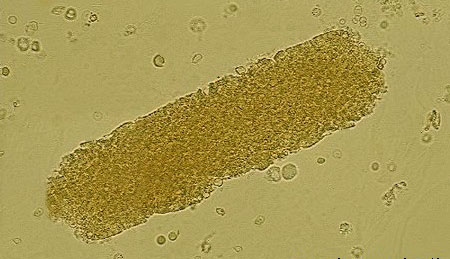 Detail Gambar Eritrosit Pada Urine Nomer 12