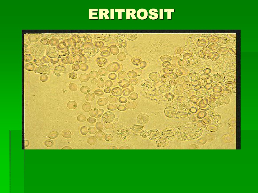 Detail Gambar Eritrosit Pada Urine Nomer 14