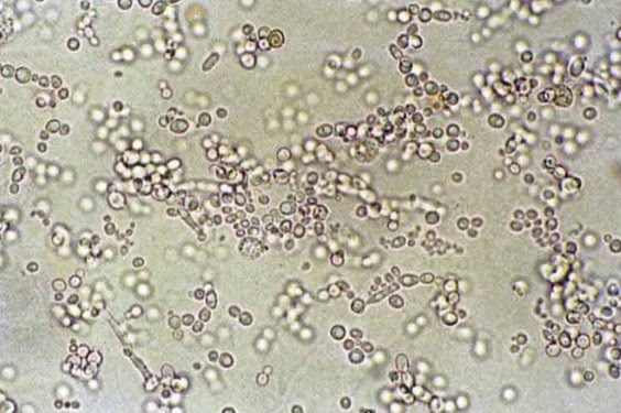 Detail Gambar Eritrosit Pada Urine Nomer 15