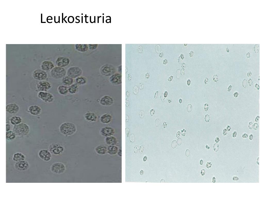 Detail Gambar Eritrosit Pada Urine Nomer 17