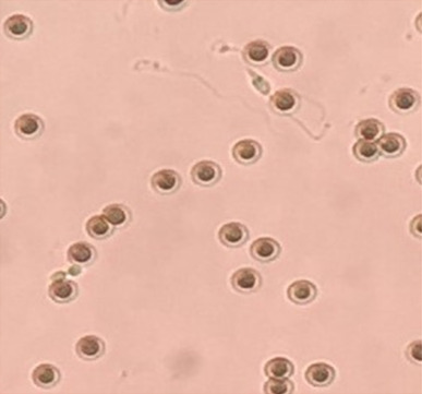 Detail Gambar Eritrosit Pada Urine Nomer 19