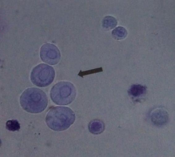 Detail Gambar Eritrosit Pada Urine Nomer 20