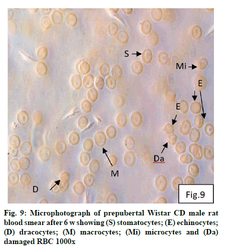 Detail Gambar Eritrosit Pada Urine Nomer 21