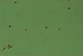 Detail Gambar Eritrosit Pada Urine Nomer 3