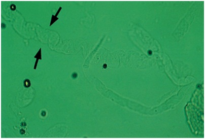 Detail Gambar Eritrosit Pada Urine Nomer 22