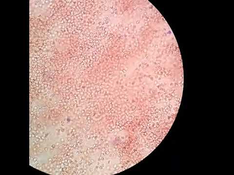 Detail Gambar Eritrosit Pada Urine Nomer 25