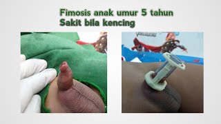 Detail Gambar Fimosis Pada Bayi Nomer 17