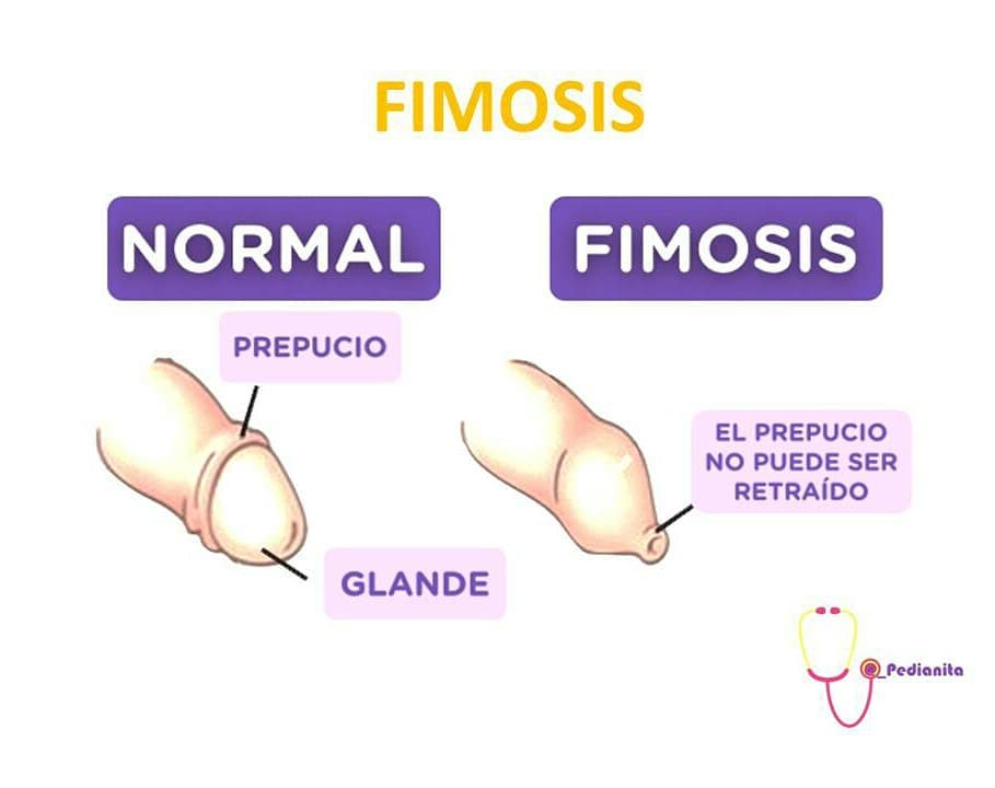 Detail Gambar Fimosis Pada Bayi Nomer 3