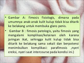 Detail Gambar Fimosis Pada Bayi Nomer 45