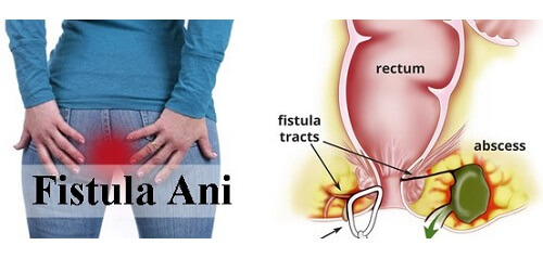 Detail Gambar Fistula Ani Nomer 5