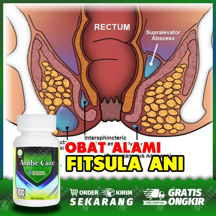 Detail Gambar Fisura Ani Nomer 33