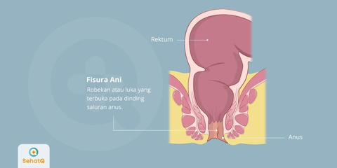 Detail Gambar Fisura Ani Nomer 8