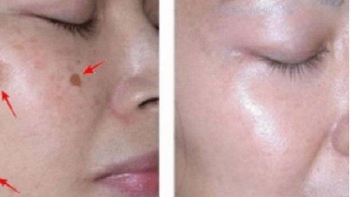 Detail Gambar Flek Hitam Di Hidung Nomer 23