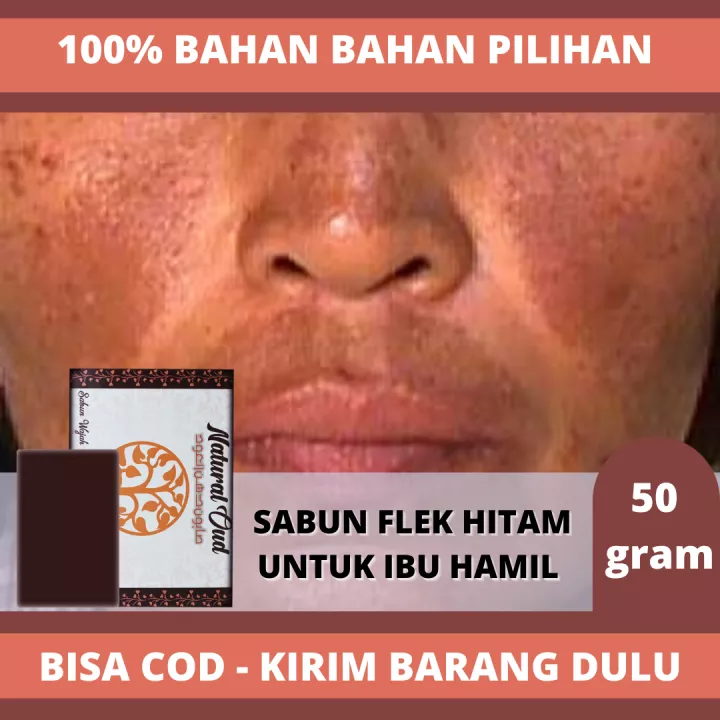 Detail Gambar Flek Hitam Di Hidung Nomer 41