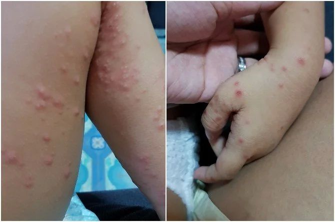 Detail Gambar Flu Singapura Pada Anak Nomer 4