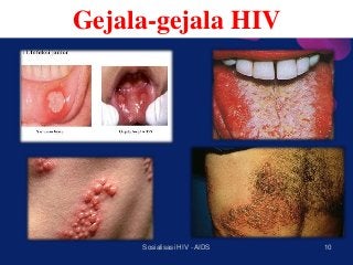 Detail Gambar Foto Penyakit Hiv Aids Nomer 29